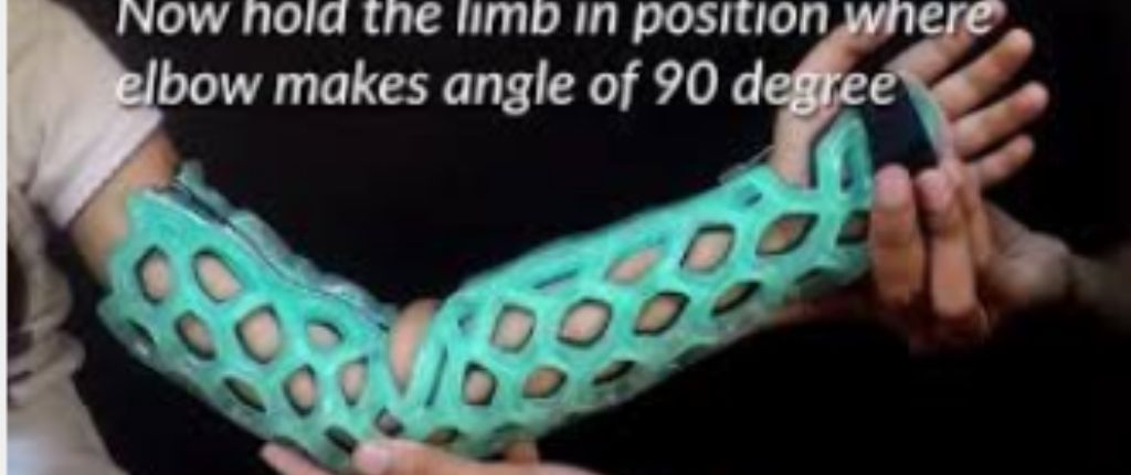The Science Behind The OrthoHeal FlexiOH Immobilizer